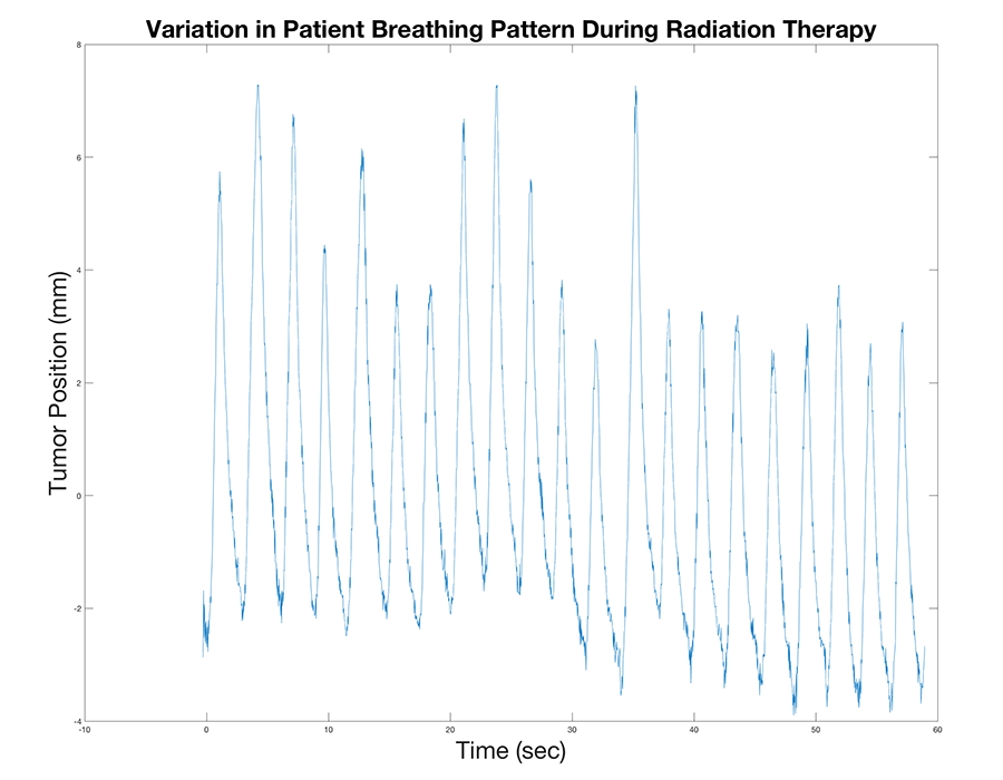 graphical depiction of variation in patient breathing pattern during radiation treatment