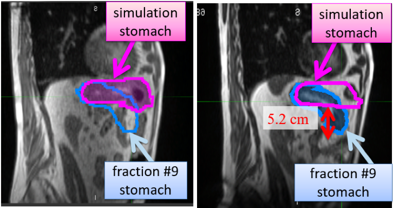 Example of interfraction stomach change from the simulation (left) to fraction #9 treatment (right) in which adaptive radiotherapy was warranted.