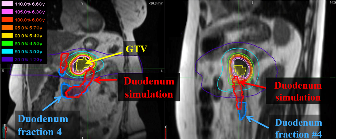 SBRT pancreatic radiotherapy case where adaptive radiotherapy was indicated due to interfraction motion of pancreas tumor to duodenum